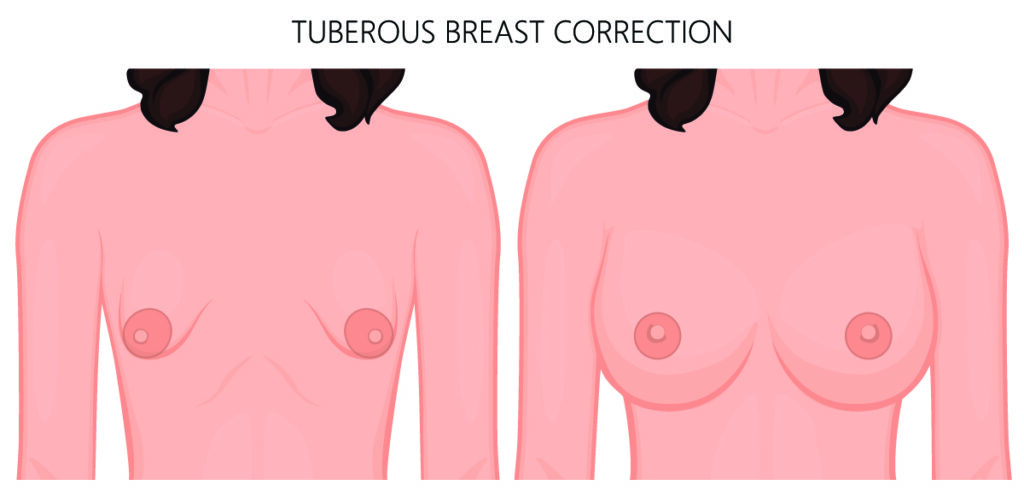 Tubular breast correction Harrison