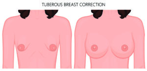 Tubular breast correction Harrison