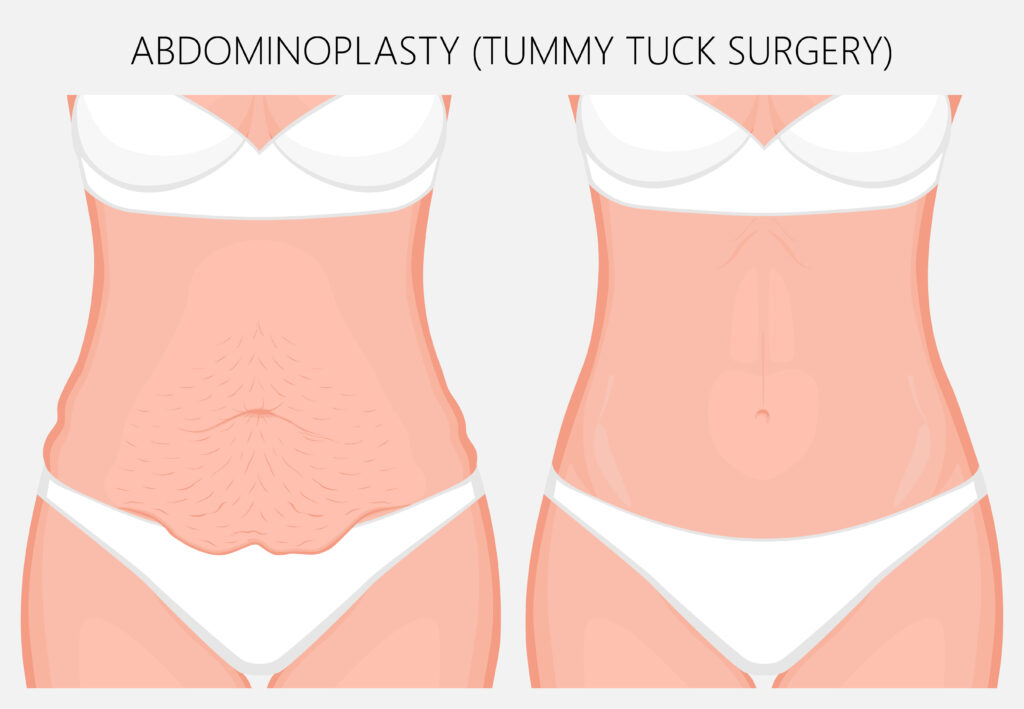 Post-bariatric surgery in NYC