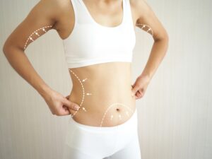 Unique Benefits of SmartLipo in NYC