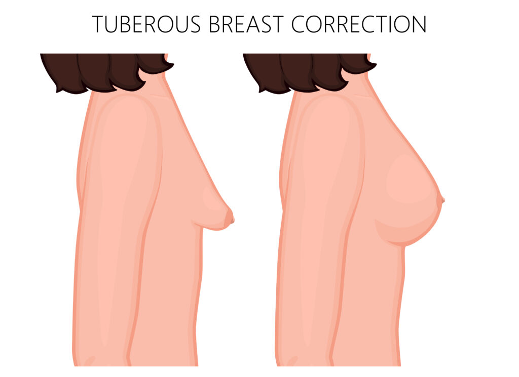 Surgery to correct tubular breasts in NYC