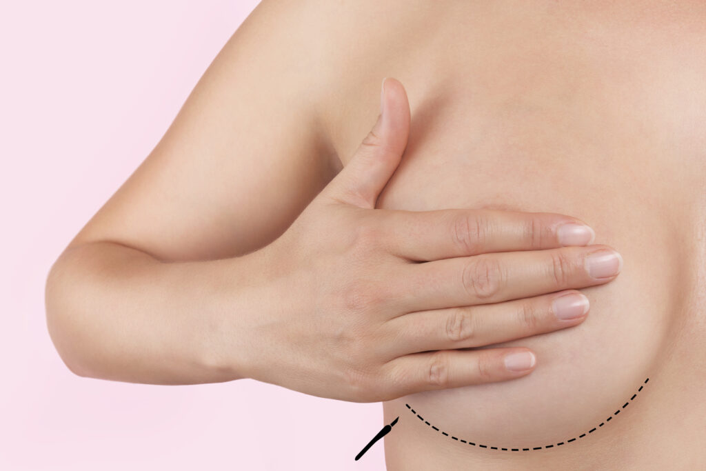 Woman's bare chest, with her hand over one breast, a dotted black line showing a breast implant revision incision