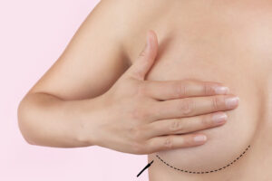 Woman's bare chest, with her hand over one breast, a dotted black line showing a breast implant revision incision