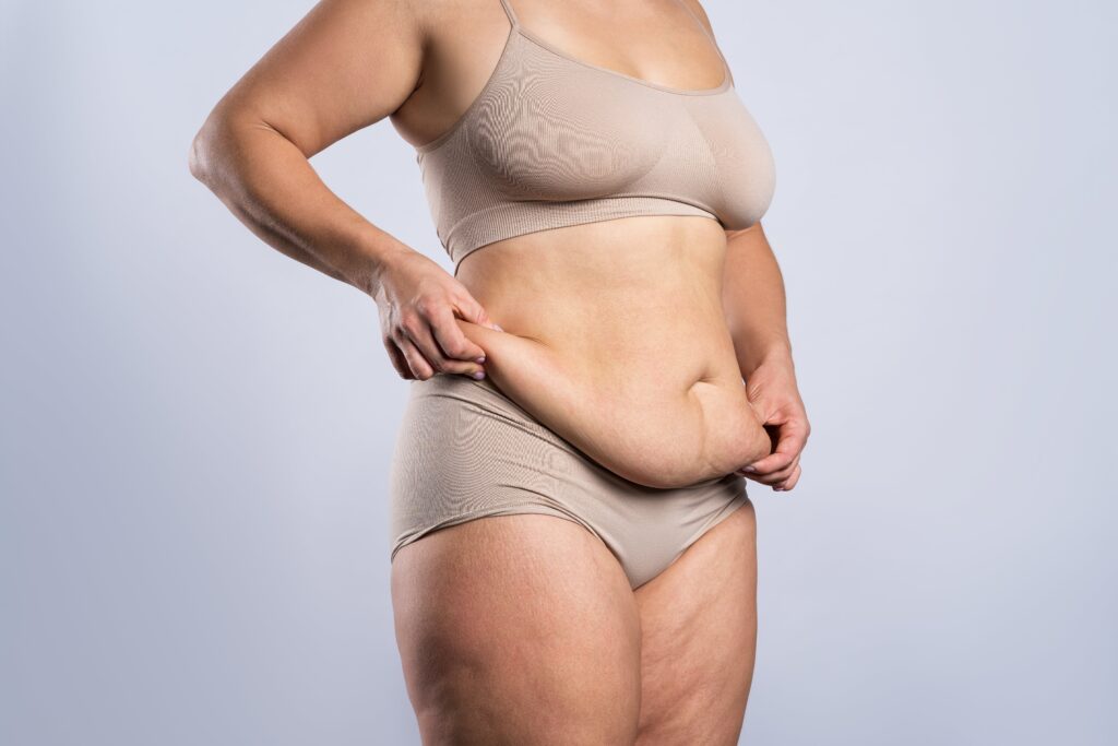 Woman grabs extra skin on her belly as she considers a tummy tuck versus lipo