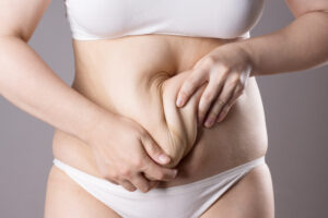 Close-up shot of woman's stomach after massive weight loss