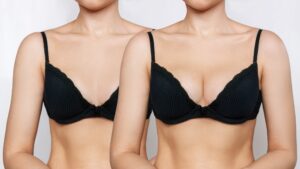 Cropped shot of a woman's breasts after Preservé™ breast augmentation