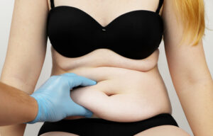 Surgeon pinching fat on a woman's stomach before tummy tuck 360
