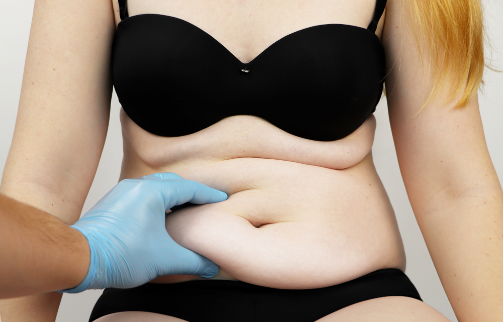 Surgeon pinching fat on a woman's stomach before tummy tuck 360