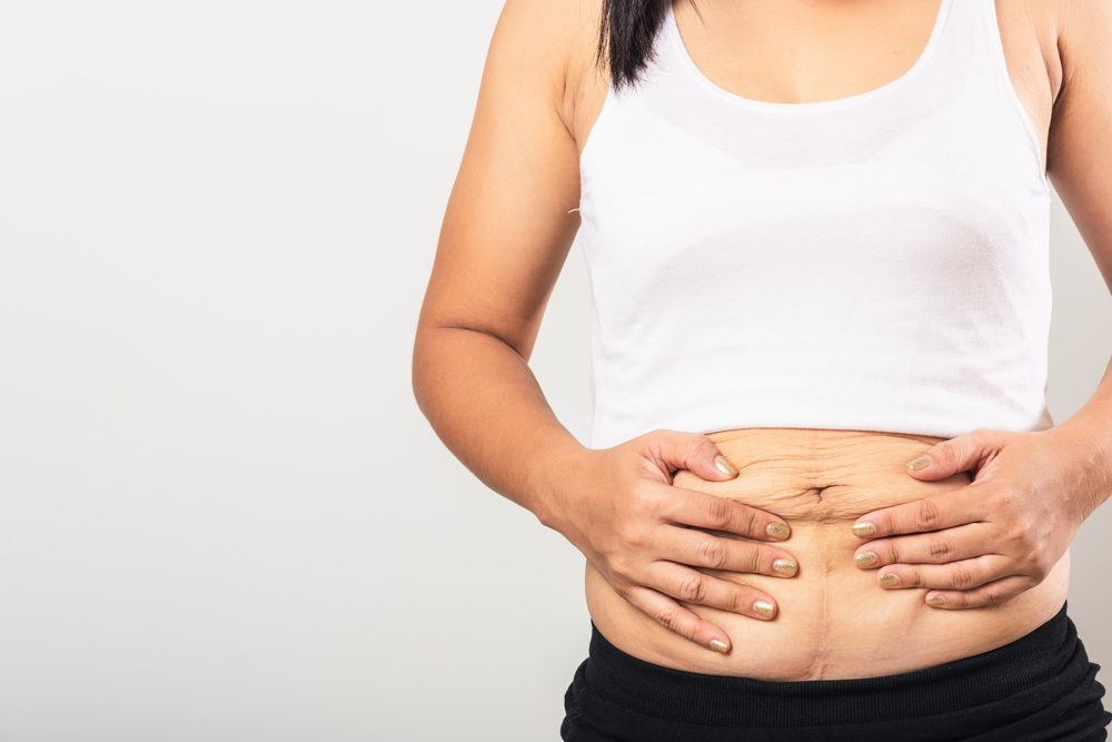 Woman's midsection with loose skin after bariatric surgery for weight loss