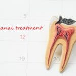 Root canal Chicago & Indianapolis