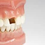 dental implants vs. dental bridges
