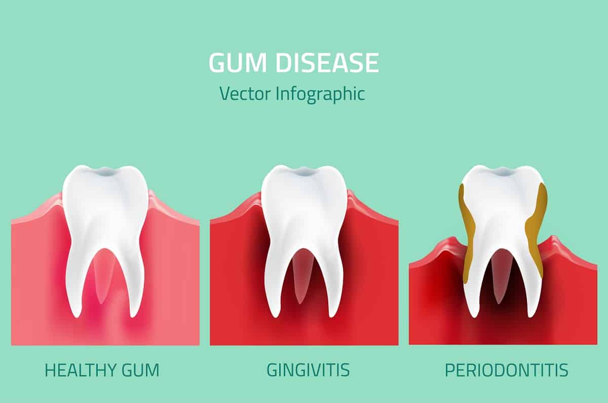 Five Health Problems Linked to Gum Disease | Dr. Raymond ...
