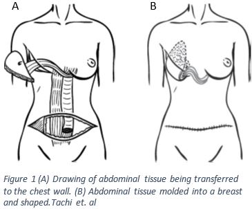 Female Chest And Abdomen Muscles, Split Framed Print