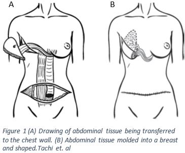 Schematic of the DIEP flap reconstructive surgery and