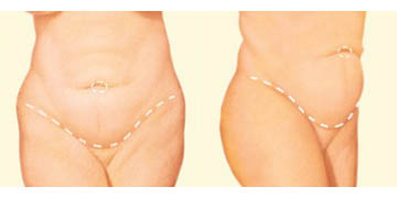 Abdominoplasty - Laser and Classic - Body Surgery - Dr Ciric