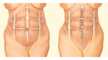 Abdominoplasty: muscle