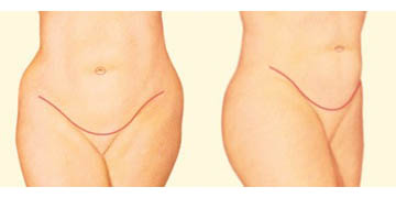 Tummy Tuck / Abdominoplasty Chicago, Burr Ridge, Elmhurst & Hinsdale, IL