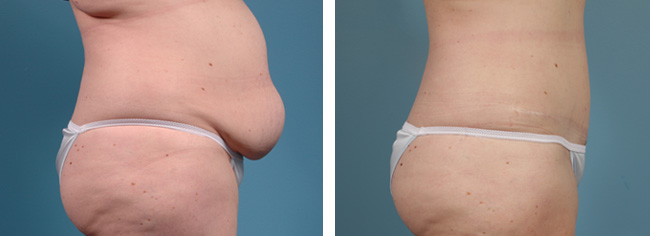 Abdominoplasty