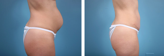 Tighten Loose Skin with a Tummy Tuck - n Chicago, Illinois