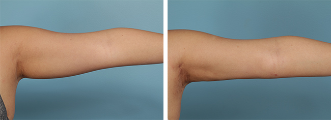 Arm liposuction