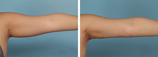 Arm Liposuction Bruising