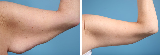 Bust and arms girdle brachioplasty liposuction, K1 (18-21 mmHg)