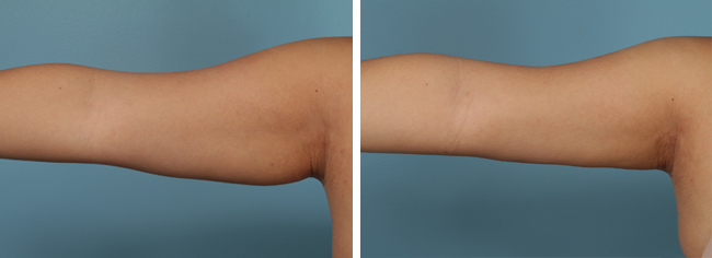 Arm liposuction