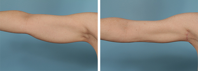 Arm liposuction