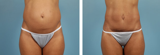 Chicago and Hinsdale Abdominoplasty and Tummy Tuck Photos