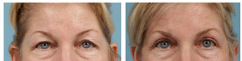 Eyelid lift: before and after