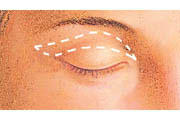 Eyelid lift diagram