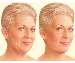 Traditional Facelift