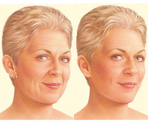 Limited Incision Facelift