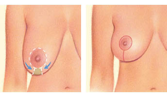 Breast lift: vertical incision
