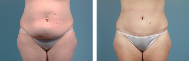 Chicago Tummy Tuck Before & After  Abdominoplasty Surgery Photos