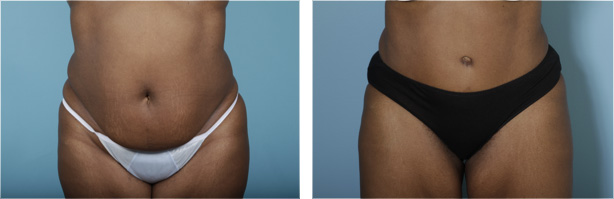 Tummy Tuck / Abdominoplasty Chicago, Burr Ridge, Elmhurst & Hinsdale, IL