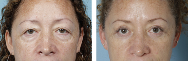 Eyelid Surgery Chicago Upper Lower Blepharoplasty Chicago Dr