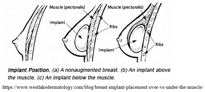 Breast Implant Animation Deformity: Causes & Treatment