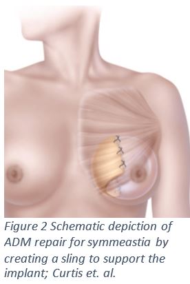 Symmastia: a Rare Complication