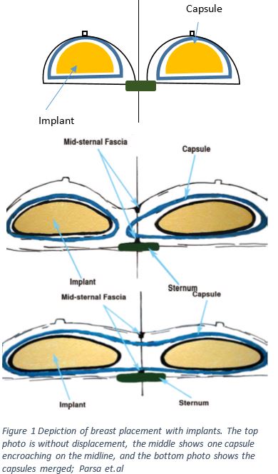 Symmastia a Rare Complication Dr. John Kim