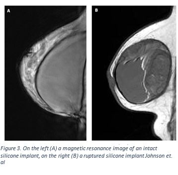 Breast Augmentation(Cohesive Gel)/ Tear Drop-Shaped (VG)