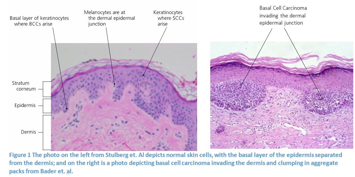 Carcinoma Slide