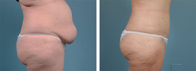 Body contouring before and after