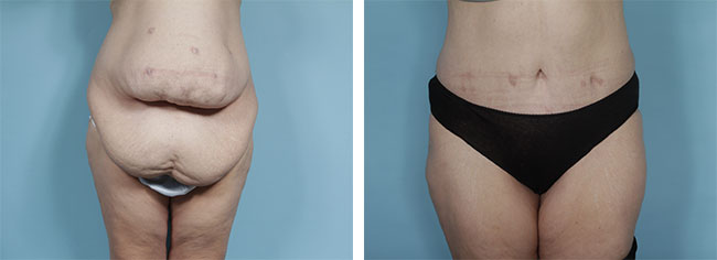 Body contouring before and after