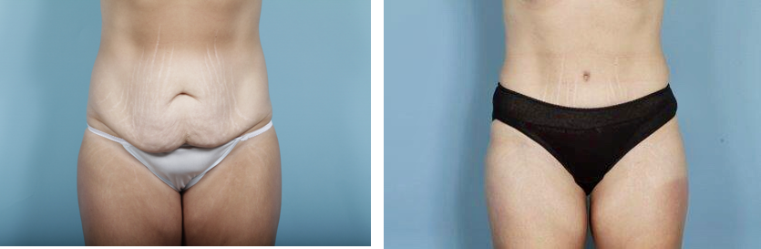 What Is A Mini Tummy Tuck?  Chicago Breast & Body Aesthetics