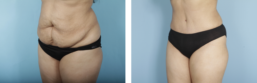 Tummy Tuck / Abdominoplasty Chicago, Burr Ridge, Elmhurst & Hinsdale, IL