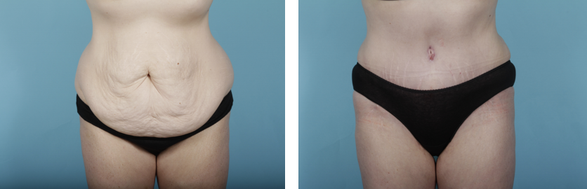 Chicago Tummy Tuck Before & After  Abdominoplasty Surgery Photos