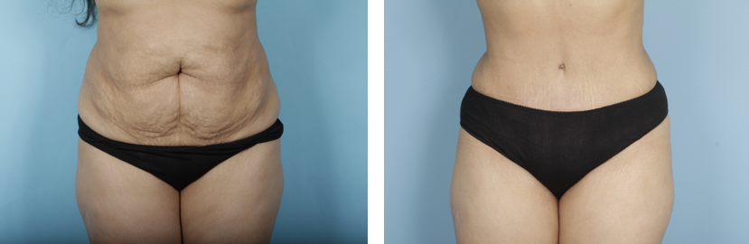 Chicago Tummy Tuck Before & After  Abdominoplasty Surgery Photos