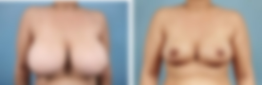 Breast Reduction Patient Photos