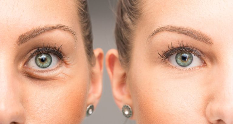 Blepharoplasty Chicago